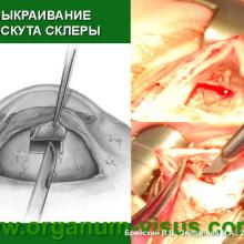 Бржеский В.В., Зерцалова М.А. Современные возможности лечения глаукомы у детей раннего возраста. Доклад на конференции «От проблемы рефракции – к проблеме глаукомы», Челябинск, 20 декабря 2013г. Glaucoma in Children. Информационный партнер www.organum-visus.com