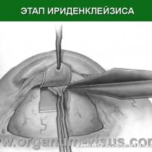 Бржеский В.В., Зерцалова М.А. Современные возможности лечения глаукомы у детей раннего возраста. Доклад на конференции «От проблемы рефракции – к проблеме глаукомы», Челябинск, 20 декабря 2013г. Glaucoma in Children. Информационный партнер www.organum-visus.com