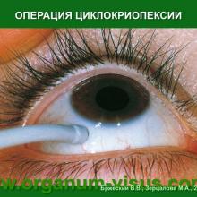 Бржеский В.В., Зерцалова М.А. Современные возможности лечения глаукомы у детей раннего возраста. Доклад на конференции «От проблемы рефракции – к проблеме глаукомы», Челябинск, 20 декабря 2013г. Glaucoma in Children. Информационный партнер www.organum-visus.com