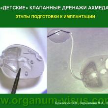 Бржеский В.В., Зерцалова М.А. Современные возможности лечения глаукомы у детей раннего возраста. Доклад на конференции «От проблемы рефракции – к проблеме глаукомы», Челябинск, 20 декабря 2013г. Glaucoma in Children. Информационный партнер www.organum-visus.com