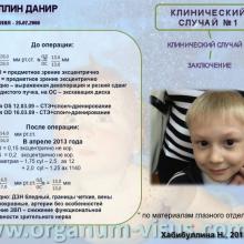 Хабибуллина Наиля Мухаметовна (ДРКБ, г. Казань) Преимущества спонч-дренирования при лечении врожденной глаукомы. Доклад на Всероссийском конгрессе «Глаукома на рубеже веков» 5-6 сентября 2013г., г. Казань, Республика Татарстан, Россия. Информационный партнер www.organum-visus.com