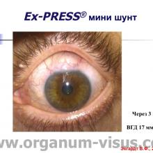Экгардт В.Ф. НГСЭ и Ex-PRESS® мини шунт в сравнительном аспекте. Доклад на Краевой конференция офтальмологов "Прикамские зори: актуальные вопросы глаукомы", 27 марта 2015г., г. Пермь, Россия. Информационный партнер www.organum-visus.com (Glaucoma)