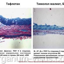 Еричев В.П. Лечение глаукомы взаимная ответственность врача и пациента. Доклад: Южно-Уральская офтальмологическая панорама, г. Челябинск, 18 декабря 2015 г. Информационный партнер портал Орган зрения www.organum-visus.com
