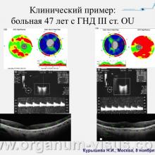 Курышева Н.И. (Центр офтальмологии ФМБА России) Лечение глаукомы: что мы знаем и что мы можем? Доклад на III международном симпозиуме "Проблемные вопросы глаукомы", 08 ноября 2014 г., г. Москва, Россия (Kurysheva N.I. Problematic issues Glaucoma. Moscow, 2014). Информационный партнер офтальмологический портал Орган зрения www.organum-visus.com