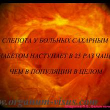 Шадричев Ф.Е. Сахарный диабет и нарушение офтальмотонуса. Доклад на сателлитном симпозиуме "Современные подходы к коррекции различных нарушений офтальмотонуса: можно ли избежать неизбежного?" (при поддержке компании "Эбботт Лэбораториз") в рамках офтальмологического конгресса Белые ночи-2015 (26 июня, г. Санкт-Петербург, Россия). Информационный партнер портал Орган зрения www.organum-visus.com