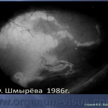 Страхов В.В. Увеосклеральный путь оттока: мифы и реальность, Uveoscleral outflow. Доклад, XII Всероссийская Школа офтальмолога, Снегири, 15 марта 2013г. Russian Glaucoma Society. Информационная поддержка www.organum-visus.com