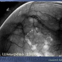 Страхов В.В. Увеосклеральный путь оттока: мифы и реальность, Uveoscleral outflow. Доклад, XII Всероссийская Школа офтальмолога, Снегири, 15 марта 2013г. Russian Glaucoma Society. Информационная поддержка www.organum-visus.com