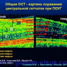 Страхов В.В. Главные патогенетические «противоречия» первичной глаукомы (г. Ярославль, Россия, 2014г.) Glaucoma pathogenesis. Информационный партнер www.organum-visus.com 