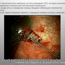 Трубилин А.В., Каира Н.А. Применение вискохирургии в процессе имплантации минишунта. Кафедра офтальмологии ФГБОУ ИПК ДПО ФМБА России, г. Москва. Научно-практическая конференция «Новые технологии в офтальмологии», 20-21 апреля 2012 г., г. Казань, Республика Татарстан, Россия. Секция молодых ученых. Viscosurgery: Mini Glaucoma Shunt Implantation. Trubilin A.V., Kaira N.A.