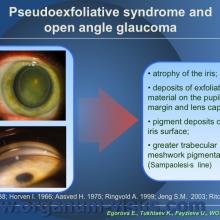 Egorova E., Tukhtaev K., Fayzieva U. Morphologic features of anterior lens capsule in the primary angle-closure glaucoma with pseudoexfoliative syndrome. 2012, февраль, 20. XXXIII World Ophthalmology Congress, Абу-Даби.