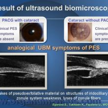 Egorova E., Tukhtaev K., Fayzieva U. Morphologic features of anterior lens capsule in the primary angle-closure glaucoma with pseudoexfoliative syndrome. 2012, февраль, 20. XXXIII World Ophthalmology Congress, Абу-Даби.