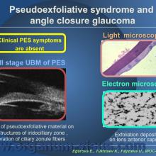 Egorova E., Tukhtaev K., Fayzieva U. Morphologic features of anterior lens capsule in the primary angle-closure glaucoma with pseudoexfoliative syndrome. 2012, февраль, 20. XXXIII World Ophthalmology Congress, Абу-Даби.