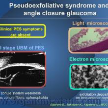 Egorova E., Tukhtaev K., Fayzieva U. Morphologic features of anterior lens capsule in the primary angle-closure glaucoma with pseudoexfoliative syndrome. 2012, февраль, 20. XXXIII World Ophthalmology Congress, Абу-Даби.