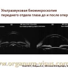Югай М.П., Рябцева А.А. Анатомо-топографические и гидродинамические изменения глаза при псевдоэксфолиативной глаукоме после ФЭК. Доклад на Всероссийском конгрессе "Глаукома на рубеже веков", 5-6 сентября 2013г. г. Казань. Media Partner www.organum-visus.com