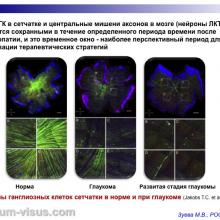 Зуева М.В. Доклинические тесты диагностики глаукомы и их роль в практическом здравоохранении. Доклад на первом Научно-практическом заседании Экспертного Совета по глаукоме. Тематика: Современные подходы к диагностике и терапии глаукомы, 14 октября 2016 (Москва), под эгидой Общероссийской общественной организации "Ассоциация врачей-офтальмологов". Информационный партнер organum-visus.ru